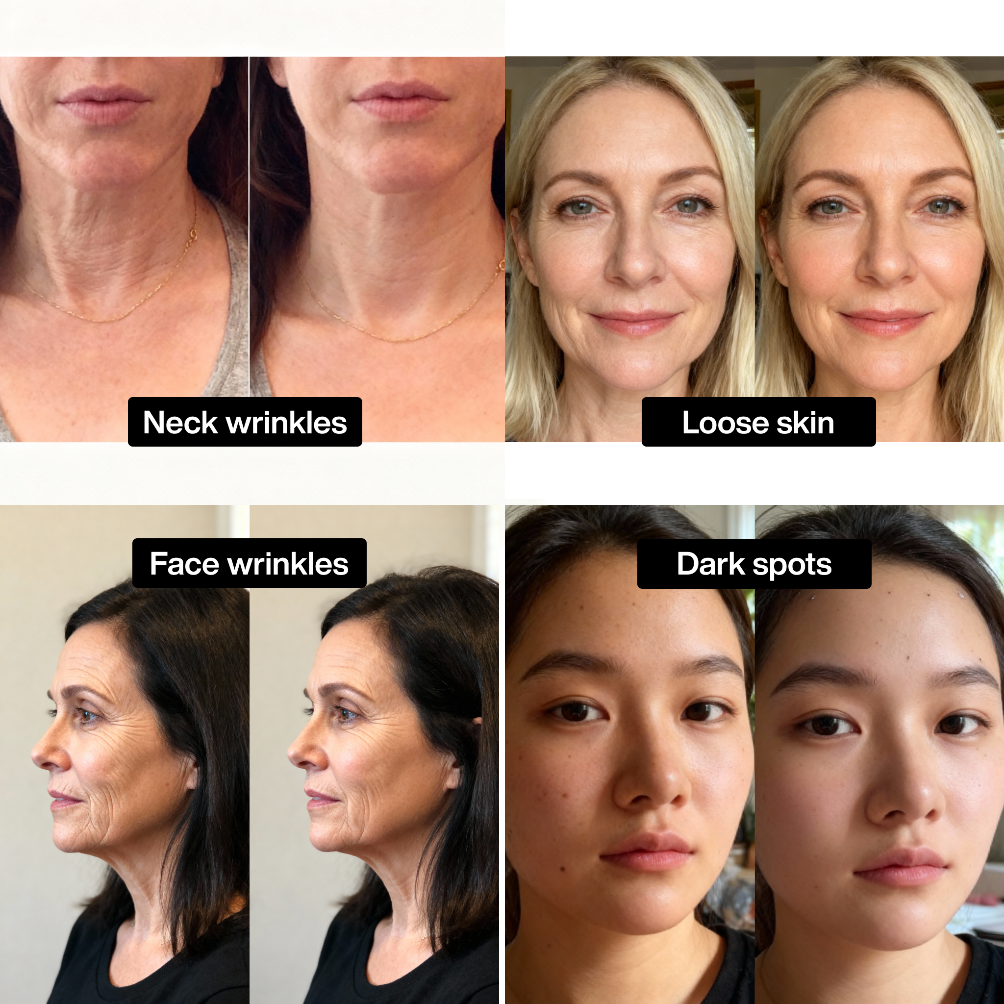 Micro Infusion Set™